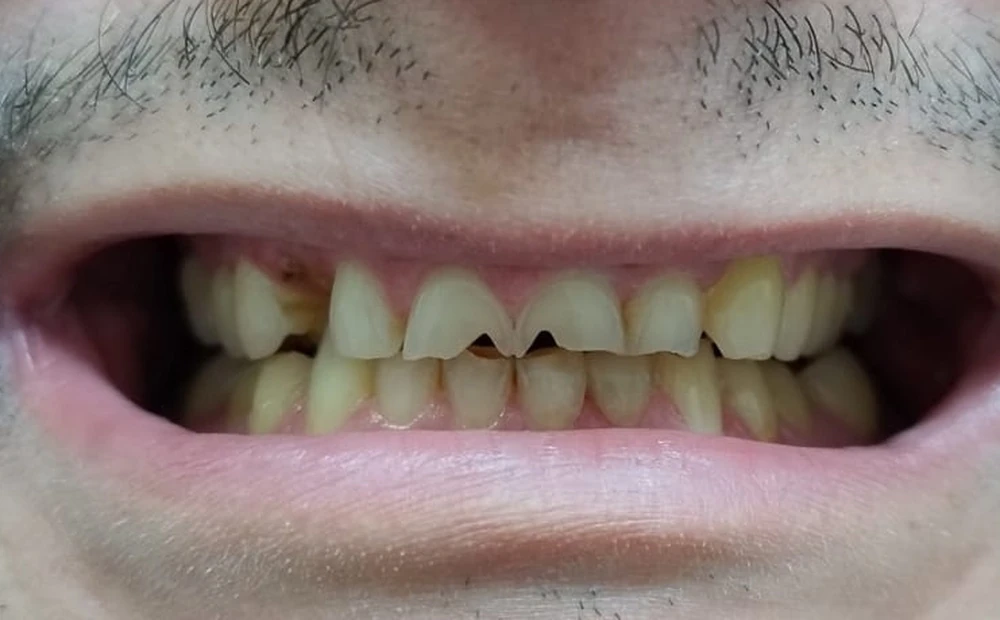 Antes do tratamento: dentes desgastados, escurecidos e com ausências