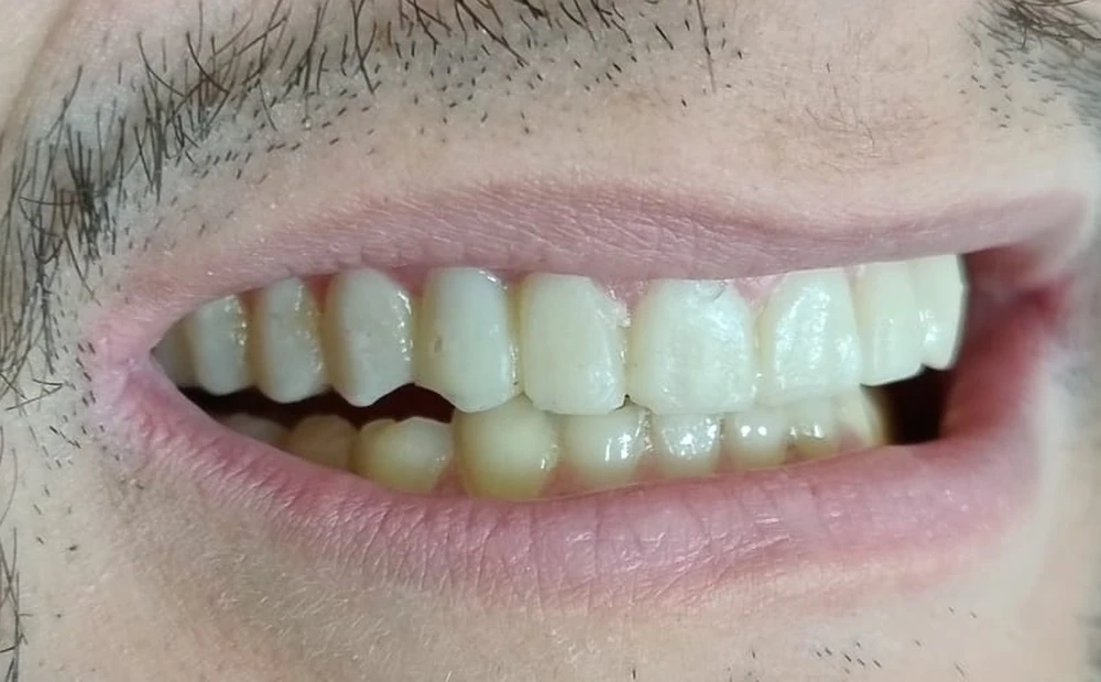 Depois do tratamento: dentes reconstruídos, uniformes e alinhados