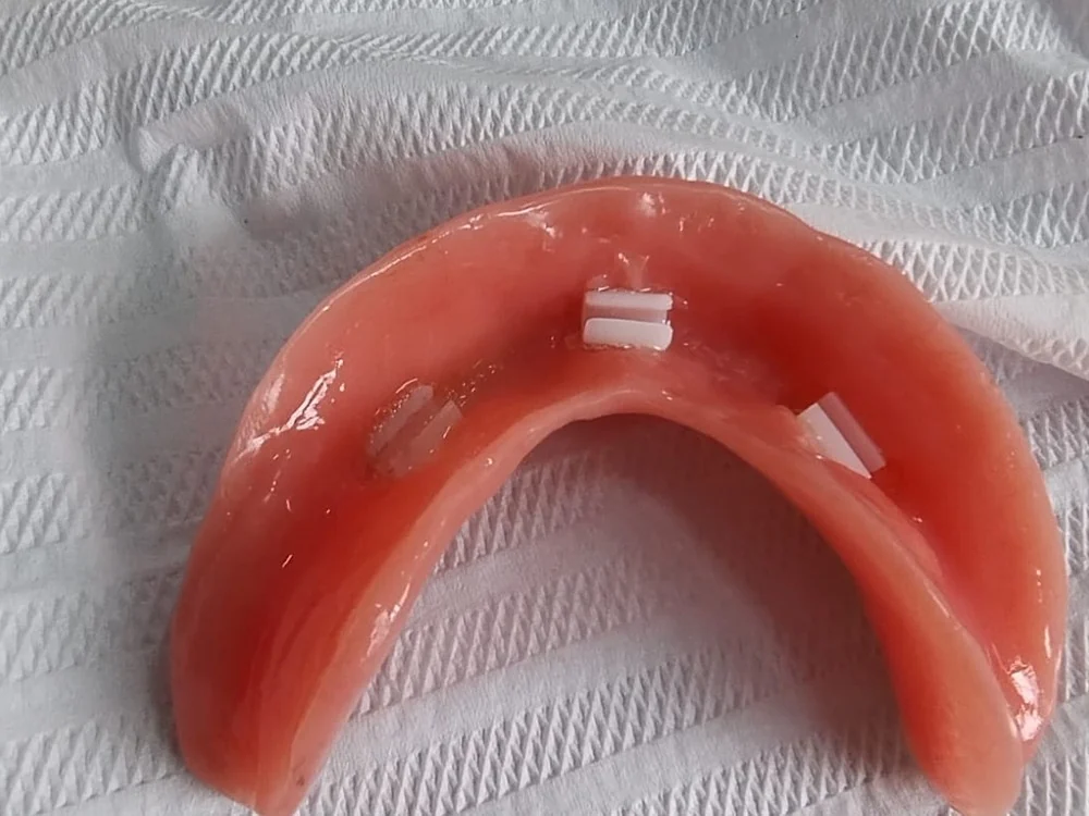 Prótese inferior com encaixes para fixação sobre implantes
