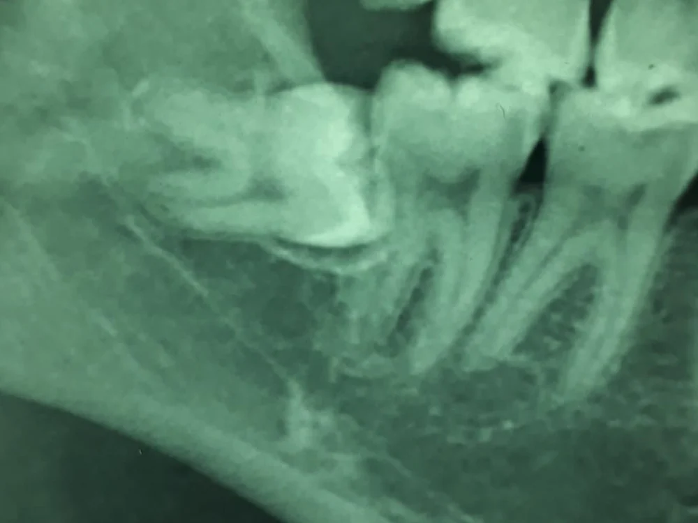 Radiografia mostrando sisos inclusos na mandíbula antes da cirurgia