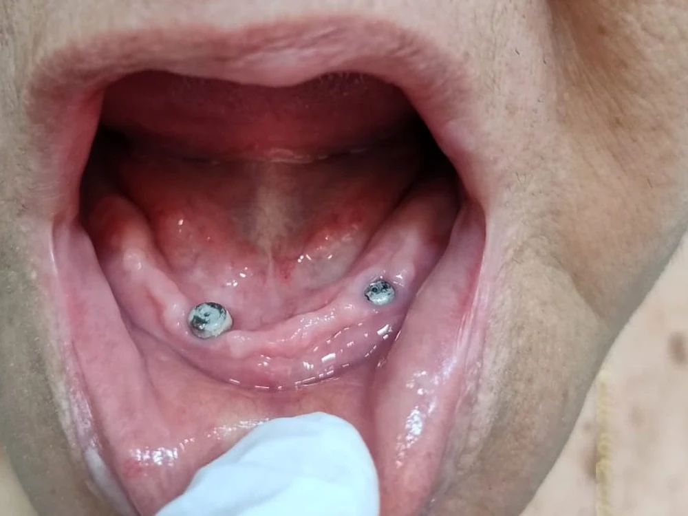 Dois implantes de titânio instalados na arcada inferior, prontos para receber a prótese